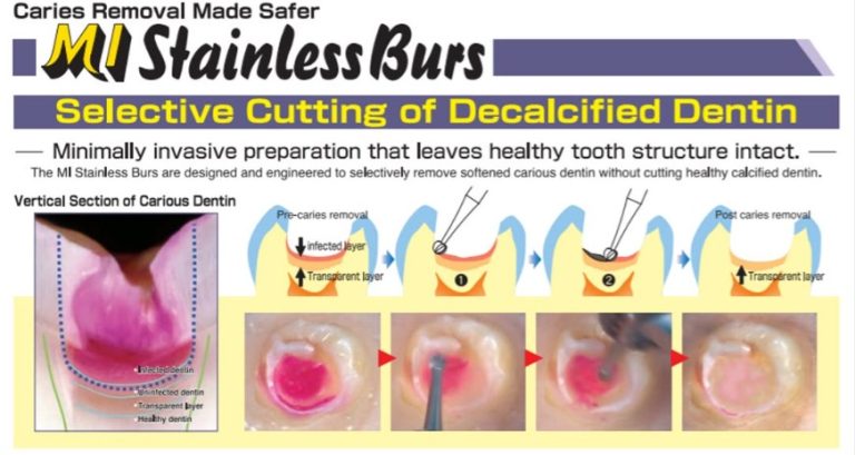 Transforming Dental Procedures with MI Stainless Burs 🦷